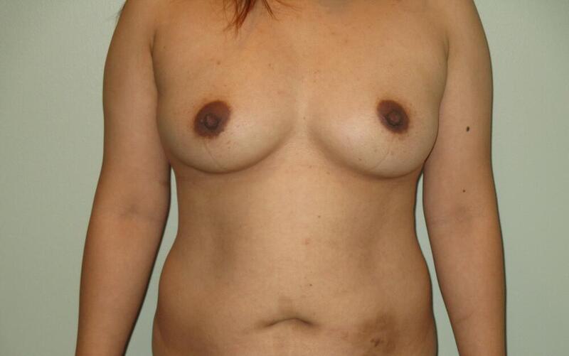 Breast Augmentation with Lift Before & After Image